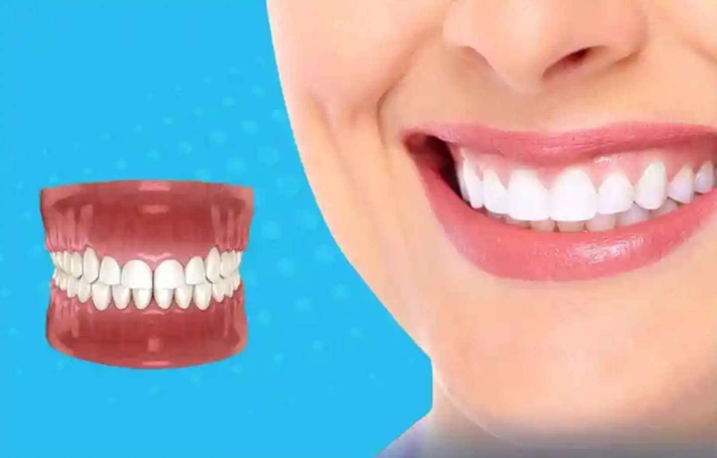 الابتسامة اللثوية وأسبابها